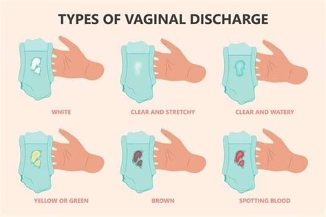 leaking fluid pregnancy|Watery fluid or discharge from vagina 